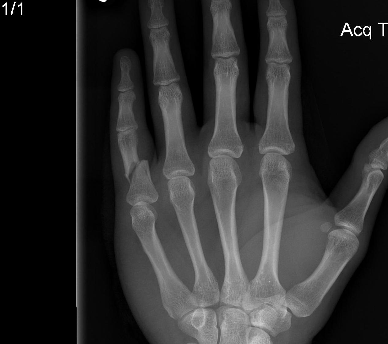 Finger Phalangeal Shaft Fracture